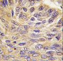 PTPN9 / MEG2 Antibody - Formalin-fixed and paraffin-embedded human lung carcinoma tissue reacted with MEG2 antibody , which was peroxidase-conjugated to the secondary antibody, followed by DAB staining. This data demonstrates the use of this antibody for immunohistochemistry; clinical relevance has not been evaluated.