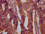 PTPN9 / MEG2 Antibody - Immunohistochemistry Dilution at 1:400 and staining in paraffin-embedded human colon cancer performed on a Leica BondTM system. After dewaxing and hydration, antigen retrieval was mediated by high pressure in a citrate buffer (pH 6.0). Section was blocked with 10% normal Goat serum 30min at RT. Then primary antibody (1% BSA) was incubated at 4°C overnight. The primary is detected by a biotinylated Secondary antibody and visualized using an HRP conjugated SP system.