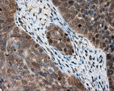 PTPRE / PTP Epsilon Antibody - Immunohistochemical staining of paraffin-embedded Adenocarcinoma of ovary tissue using anti-PTPRE mouse monoclonal antibody. (Dilution 1:50).