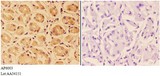 PTPRO Antibody - Immunohistochemistry (IHC) analysis of PTPRO antibody in paraffin-embedded human stomach carcinoma tissue at 1:50, showing cytoplasm and membrane staining. Negative control (the right) using PBS instead of primary antibody. Secondary antibody is Goat Anti-Rabbit.