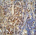 PUS3 Antibody - PUS3 antibody immunohistochemistry of formalin-fixed and paraffin-embedded human lung carcinoma followed by peroxidase-conjugated secondary antibody and DAB staining.