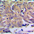 PXMP2 Antibody - Immunohistochemical analysis of PXMP2 staining in human prostate cancer formalin fixed paraffin embedded tissue section. The section was pre-treated using heat mediated antigen retrieval with sodium citrate buffer (pH 6.0). The section was then incubated with the antibody at room temperature and detected using an HRP-conjugated compact polymer system. DAB was used as the chromogen. The section was then counterstained with hematoxylin and mounted with DPX.