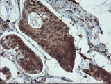PYCARD / ASC / TMS1 Antibody - IHC of paraffin-embedded Carcinoma of Human pancreas tissue using anti-PYCARD mouse monoclonal antibody.
