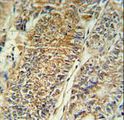 PYCR1 Antibody - PYCR1 Antibody IHC of formalin-fixed and paraffin-embedded colon carcinoma followed by peroxidase-conjugated secondary antibody and DAB staining.