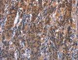 R3HCC1L / C10orf28 Antibody - Immunohistochemistry of paraffin-embedded Human gastric cancer using R3HCC1L Polyclonal Antibody at dilution of 1:40.