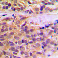RAB11FIP1 Antibody - Immunohistochemical analysis of RAB11FIP1 staining in human prostate cancer formalin fixed paraffin embedded tissue section. The section was pre-treated using heat mediated antigen retrieval with sodium citrate buffer (pH 6.0). The section was then incubated with the antibody at room temperature and detected using an HRP-conjugated compact polymer system. DAB was used as the chromogen. The section was then counterstained with hematoxylin and mounted with DPX.
