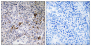 RAB11FIP3 Antibody - Immunohistochemistry analysis of paraffin-embedded human lung carcinoma tissue, using RAB11FIP3 Antibody. The picture on the right is blocked with the synthesized peptide.