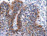 RAB25 Antibody - Immunohistochemistry of paraffin-embedded Human liver cancer using RAB25 Polyclonal Antibody at dilution of 1:50.