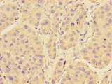 RAB28 Antibody - Immunohistochemistry of paraffin-embedded human liver cancer tissue using RAB28 Antibody at dilution of 1:100