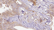 RAB3A Antibody - 1:100 staining human thyroid carcinoma tissue by IHC-P. The sample was formaldehyde fixed and a heat mediated antigen retrieval step in citrate buffer was performed. The sample was then blocked and incubated with the antibody for 1.5 hours at 22°C. An HRP conjugated goat anti-rabbit antibody was used as the secondary.