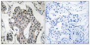 RAB3GAP2 / p150 Antibody - Immunohistochemistry analysis of paraffin-embedded human breast carcinoma tissue, using RAB3GAP2 Antibody. The picture on the right is blocked with the synthesized peptide.