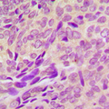 RAB41 Antibody - Immunohistochemical analysis of RAB41 staining in human breast cancer formalin fixed paraffin embedded tissue section. The section was pre-treated using heat mediated antigen retrieval with sodium citrate buffer (pH 6.0). The section was then incubated with the antibody at room temperature and detected using an HRP-conjugated compact polymer system. DAB was used as the chromogen. The section was then counterstained with hematoxylin and mounted with DPX.