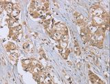 RAB6C Antibody - Immunohistochemistry of paraffin-embedded Human breast cancer using RAB6C Polyclonal Antibody at dilution of 1:45.