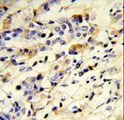 Antibody - Formalin-fixed and paraffin-embedded human breast carcinoma reacted with IGHM Antibody , which was peroxidase-conjugated to the secondary antibody, followed by DAB staining. This data demonstrates the use of this antibody for immunohistochemistry; clinical relevance has not been evaluated.