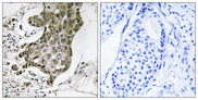 RABEP1 / Rabaptin-5 Antibody - Immunohistochemistry analysis of paraffin-embedded human breast carcinoma tissue, using RABEP1 Antibody. The picture on the right is blocked with the synthesized peptide.