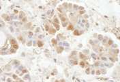 RABGEF1 Antibody - Detection of Human RABGEF1 by Immunohistochemistry. Sample: FFPE section of human lung carcinoma. Antibody: Affinity purified rabbit anti-RABGEF1 used at a dilution of 1:1000 (1 ug/ml). Detection: DAB.