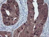 RABL2A Antibody - IHC of paraffin-embedded Adenocarcinoma of Human endometrium tissue using anti-RABL2A mouse monoclonal antibody.
