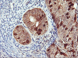 RABL2A Antibody - IHC of paraffin-embedded Adenocarcinoma of Human endometrium tissue using anti-RABL2A mouse monoclonal antibody.