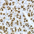 RAC1 Antibody - Immunohistochemical analysis of Rac 1 staining in human gastric cancer formalin fixed paraffin embedded tissue section. The section was pre-treated using heat mediated antigen retrieval with sodium citrate buffer (pH 6.0). The section was then incubated with the antibody at room temperature and detected using an HRP conjugated compact polymer system. DAB was used as the chromogen. The section was then counterstained with hematoxylin and mounted with DPX.