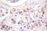 RAD17 Antibody - IHC of Rad17 (A639) pAb in paraffin-embedded human breast carcinoma tissue.