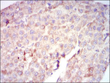 RAF1 / RAF Antibody - IHC of paraffin-embedded liver cancer tissues using RAF1 mouse monoclonal antibody with DAB staining.