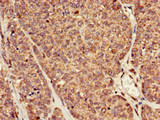 RAI1 Antibody - Immunohistochemistry of paraffin-embedded human ovarian cancer at dilution of 1:100
