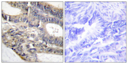 RALGAPA2 Antibody - Immunohistochemistry analysis of paraffin-embedded human colon carcinoma tissue, using AS250 Antibody. The picture on the right is blocked with the synthesized peptide.