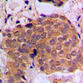 RAN Antibody - Immunohistochemical analysis of RAN staining in human breast cancer formalin fixed paraffin embedded tissue section. The section was pre-treated using heat mediated antigen retrieval with sodium citrate buffer (pH 6.0). The section was then incubated with the antibody at room temperature and detected using an HRP conjugated compact polymer system. DAB was used as the chromogen. The section was then counterstained with hematoxylin and mounted with DPX.