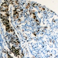 RAP30 / GTF2F2 Antibody - Immunohistochemical analysis of TFIIF RAP 30 staining in human colon cancer formalin fixed paraffin embedded tissue section. The section was pre-treated using heat mediated antigen retrieval with sodium citrate buffer (pH 6.0). The section was then incubated with the antibody at room temperature and detected using an HRP conjugated compact polymer system. DAB was used as the chromogen. The section was then counterstained with hematoxylin and mounted with DPX.