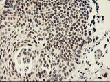 RAP74 / GTF2F1 Antibody - IHC of paraffin-embedded Carcinoma of Human bladder tissue using anti-GTF2F1 mouse monoclonal antibody.