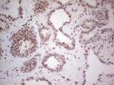 RARA / RAR Alpha Antibody - IHC of paraffin-embedded Carcinoma of Human prostate tissue using anti-RARA mouse monoclonal antibody. (Heat-induced epitope retrieval by 1 mM EDTA in 10mM Tris, pH8.5, 120°C for 3min).