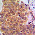 RARB / RAR Beta Antibody - Immunohistochemical analysis of RAR beta staining in human breast cancer formalin fixed paraffin embedded tissue section. The section was pre-treated using heat mediated antigen retrieval with sodium citrate buffer (pH 6.0). The section was then incubated with the antibody at room temperature and detected using an HRP conjugated compact polymer system. DAB was used as the chromogen. The section was then counterstained with hematoxylin and mounted with DPX.