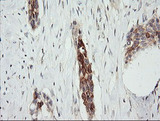 RARRES1 Antibody - IHC of paraffin-embedded Carcinoma of Human bladder tissue using anti-RARRES1 mouse monoclonal antibody.