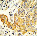 RARS2 / ARGRS Antibody - Formalin-fixed and paraffin-embedded human Lung carcinoma reacted with RARS2 Antibody , which was peroxidase-conjugated to the secondary antibody, followed by DAB staining. This data demonstrates the use of this antibody for immunohistochemistry; clinical relevance has not been evaluated.