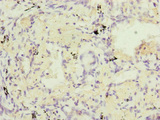 RARS2 / ARGRS Antibody - Immunohistochemistry of paraffin-embedded human lung cancer at dilution of 1:100