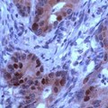 RB1 / Retinoblastoma / RB Antibody - Colon carcinoma stained with Anti-RB antibody