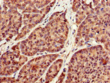 RBFA Antibody - Immunohistochemistry of paraffin-embedded human ovarian cancer at dilution of 1:100