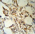RBM3 Antibody - RBM3 Antibody (RB18777) IHC of formalin-fixed and paraffin-embedded human breast carcinoma followed by peroxidase-conjugated secondary antibody and DAB staining.