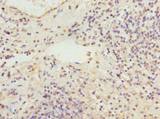 RBMS2 / SCR3 Antibody - Immunohistochemistry of paraffin-embedded human cervical cancer using antibody at dilution of 1:100.