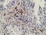 RBP1 / CRBP Antibody - IHC of paraffin-embedded Adenocarcinoma of Human ovary tissue using anti-RBP1 mouse monoclonal antibody.