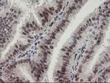 RBPMS / Hermes Antibody - IHC of paraffin-embedded Adenocarcinoma of Human endometrium tissue using anti-RBPMS mouse monoclonal antibody.