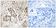 RCC2 Antibody - Immunohistochemistry analysis of paraffin-embedded human breast carcinoma tissue, using RCC2 Antibody. The picture on the right is blocked with the synthesized peptide.