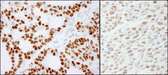 RCC2 Antibody - Detection of Human and Mouse RCC2 by Immunohistochemistry. Sample: FFPE sections of human skin basal cell carcinoma (left) and mouse CT26 colon carcinoma (right). Antibody: Affinity purified rabbit anti-RCC2 used at a dilution of 1:1000 (0.2 ug/ml) and 1:200 (1 ug/ml). Detection: DAB.