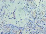 RD / PHYH Antibody - Immunohistochemistry of paraffin-embedded human breast cancer using antibody at 1:100 dilution.