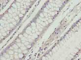 RD3 Antibody - Immunohistochemistry of paraffin-embedded human colon cancer using antibody at dilution of 1:100.
