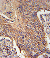 RDH10 Antibody - RDH10 Antibody immunohistochemistry of formalin-fixed and paraffin-embedded lung carcinoma followed by peroxidase-conjugated secondary antibody and DAB staining.