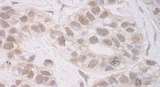 RECQ5 / RECQL5 Antibody - Detection of Human RECQ5 by Immunohistochemistry. Sample: FFPE section of human breast carcinoma. Antibody: Affinity purified rabbit anti-RECQ5 used at a dilution of 1:1000 (1 ug/ml). Detection: DAB.