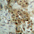 RELB Antibody - Immunohistochemical analysis of RELB (pS573) staining in human breast cancer formalin fixed paraffin embedded tissue section. The section was pre-treated using heat mediated antigen retrieval with sodium citrate buffer (pH 6.0). The section was then incubated with the antibody at room temperature and detected using an HRP conjugated compact polymer system. DAB was used as the chromogen. The section was then counterstained with hematoxylin and mounted with DPX.