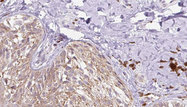 RELN / Reelin Antibody - 1:100 staining human Melanoma tissue by IHC-P. The sample was formaldehyde fixed and a heat mediated antigen retrieval step in citrate buffer was performed. The sample was then blocked and incubated with the antibody for 1.5 hours at 22°C. An HRP conjugated goat anti-rabbit antibody was used as the secondary.