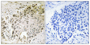 RFX2 Antibody - Immunohistochemistry analysis of paraffin-embedded human lung carcinoma, using RFX2 Antibody. The picture on the right is blocked with the synthesized peptide.